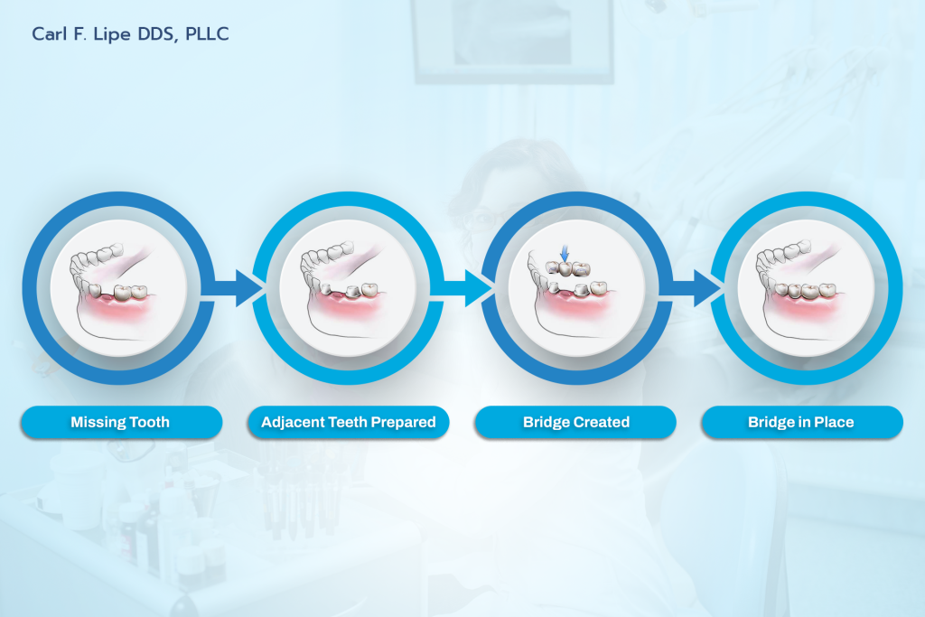 Benefits of Dental Bridges