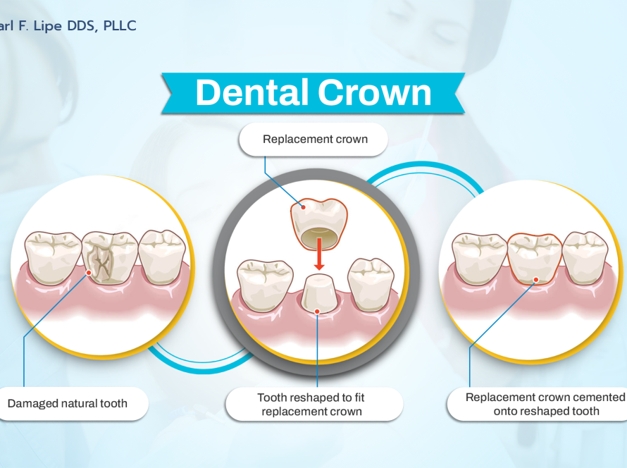 Dental Crowns denver