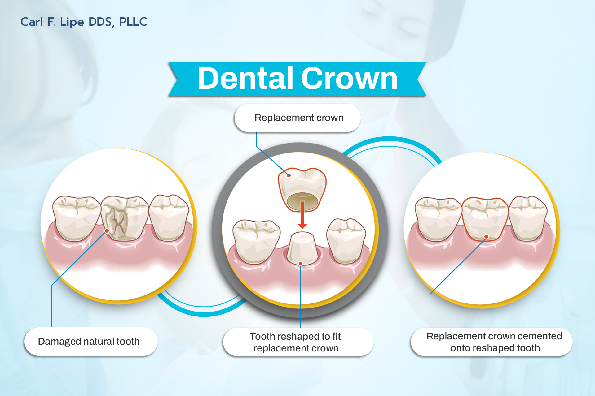 Dental Crown in Denver