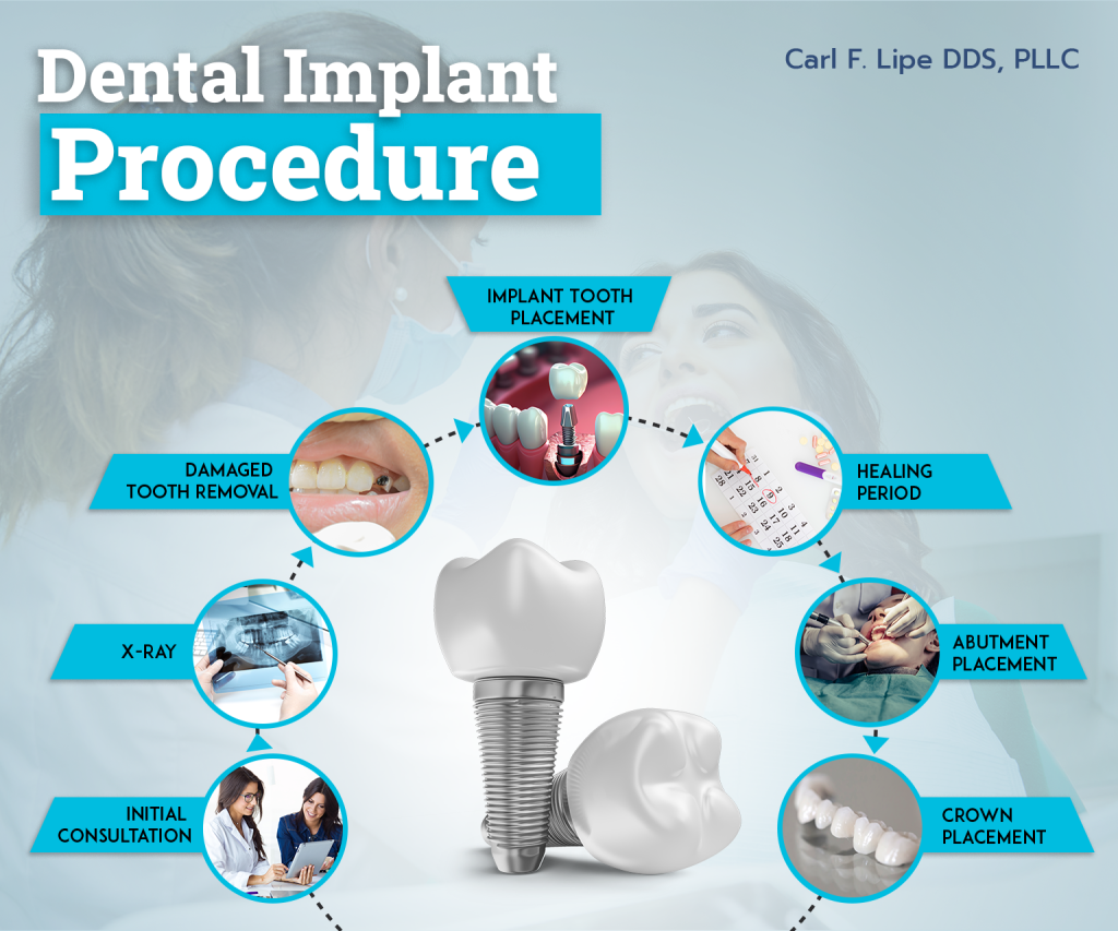 Dental Implant Procedure in denver