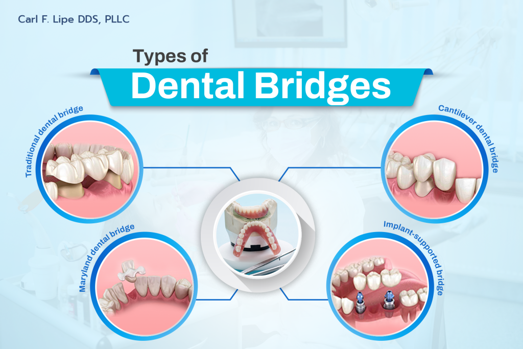 Types of Dental Bridges