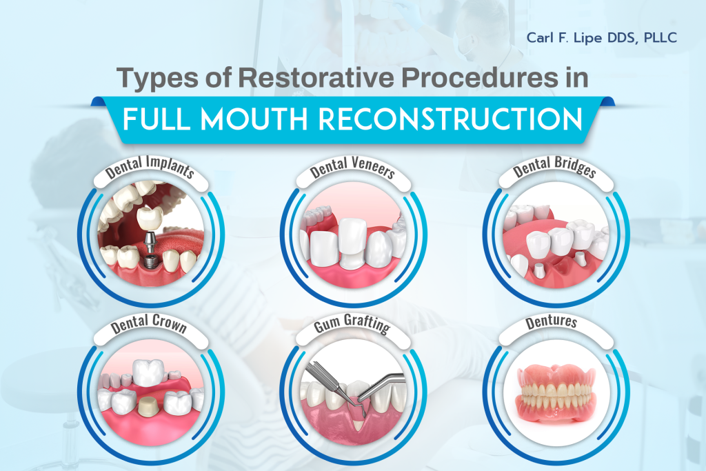 Procedures Included in Full Mouth Reconstruction