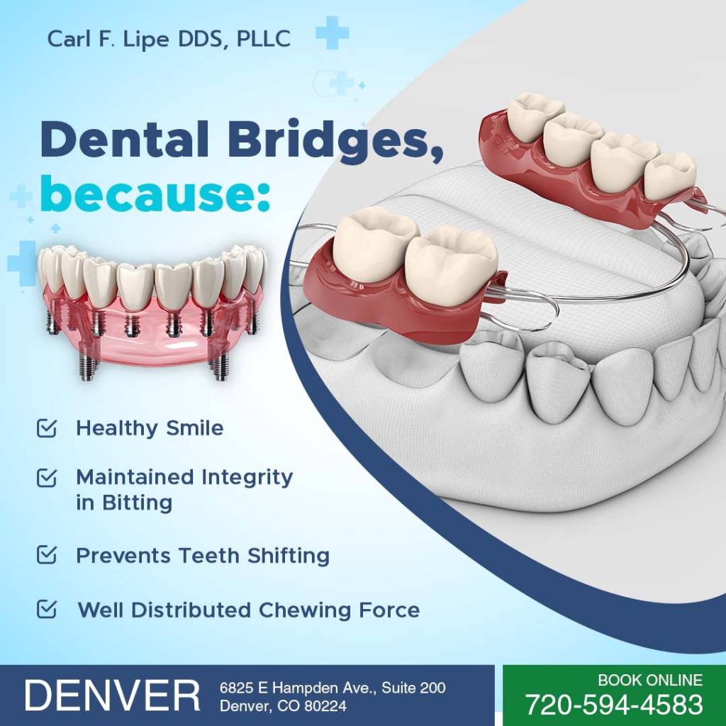 What are Dental Bridges?