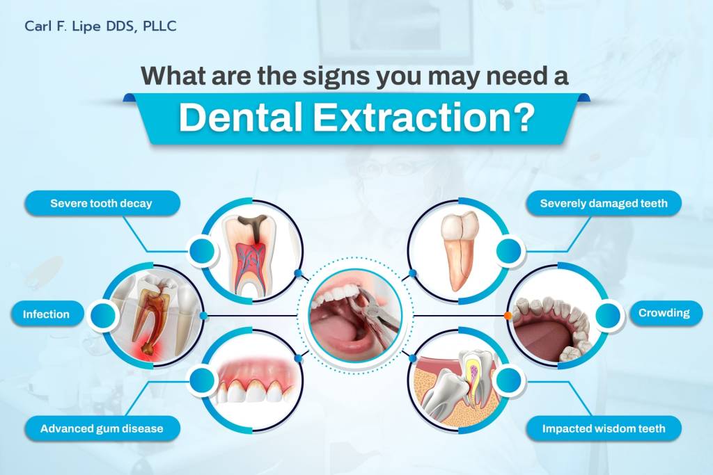 The Top Signs a Tooth Extraction is Needed