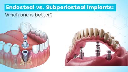 Endosteal vs. Subperiosteal Implants