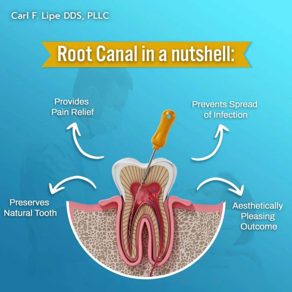 what is root canal treatment?