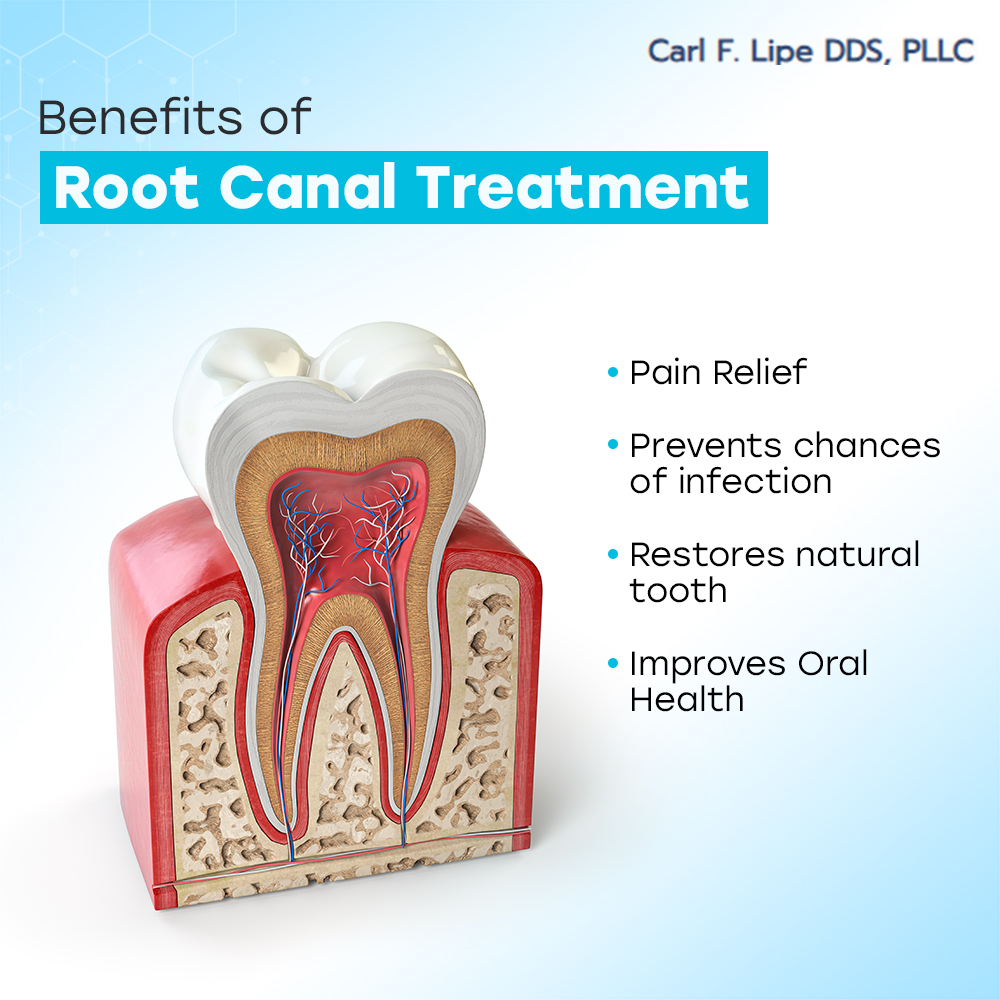 Benefits of Root Canal Treatment