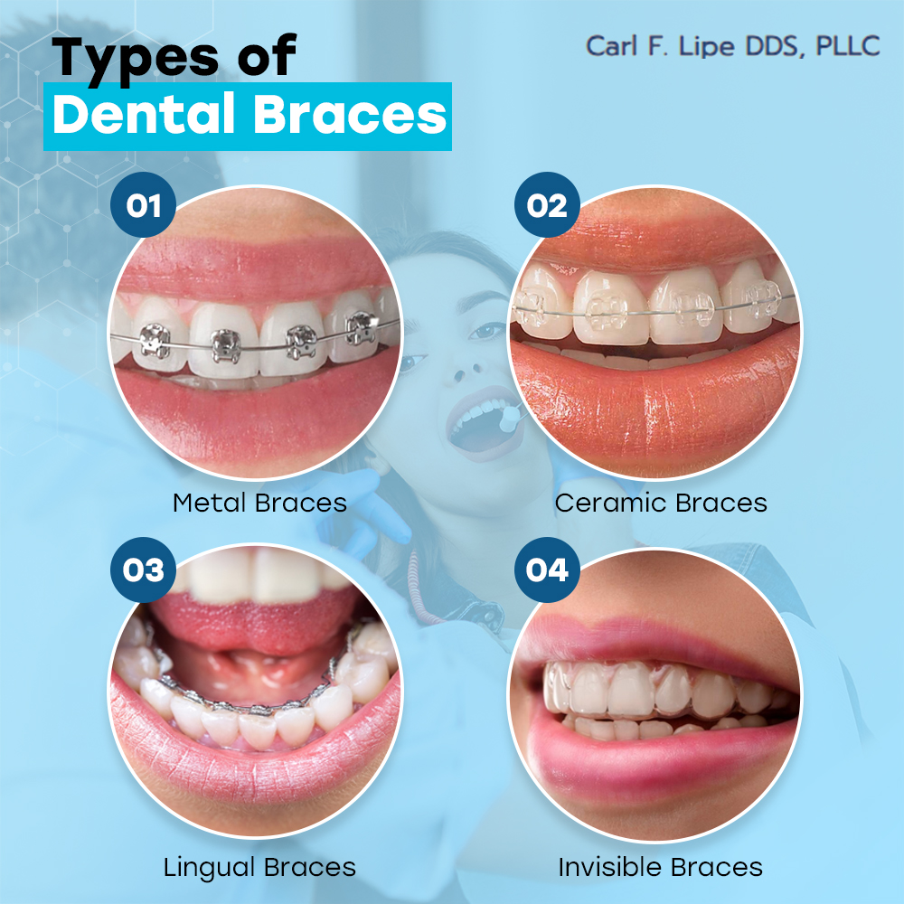 Dental Braces Types