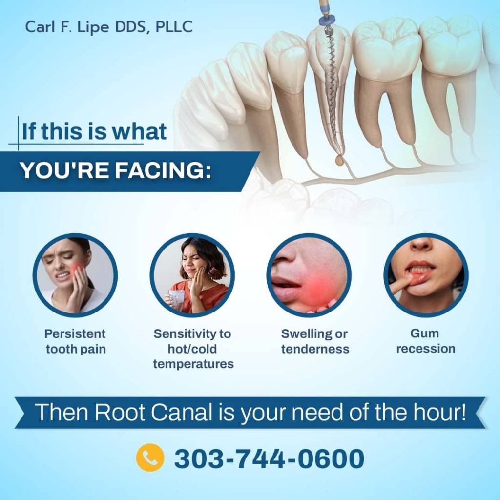 How Do You Know When You Need Root Canal Treatment ? 