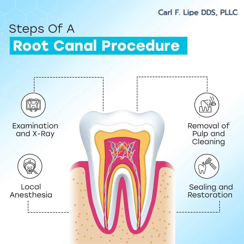 Steps Involved In A Root Canal Procedure