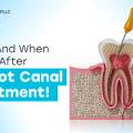 Healing After a Root Canal: What to Eat & What to Avoid After Root Canal Treatment