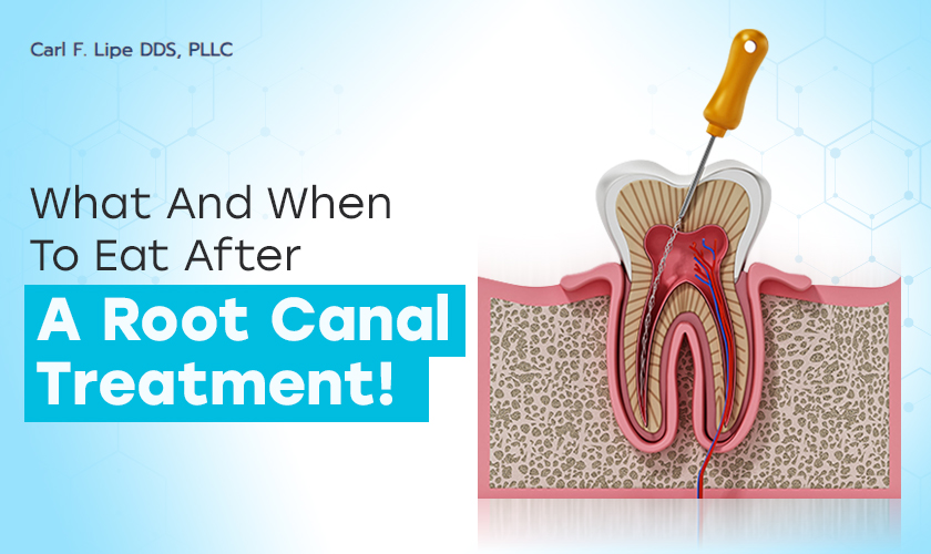 What And When To Eat After A Root Canal Treatment!